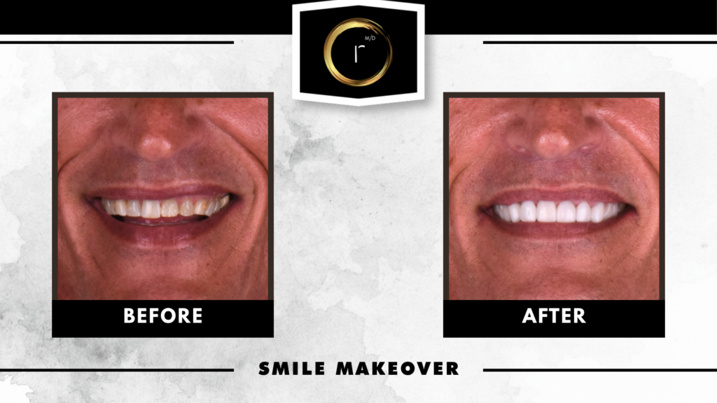 Before and after smile makeover completed at Restore Modern Dentistry in Bentonville, Arkansas, featuring a cosmetic dentistry transformation with brighter, natural-looking teeth for a patient in Northwest Arkansas.